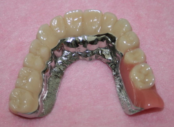 Mit gaumenplatte oberkiefer zahnprothese Patientenfrage: Zahnprothese
